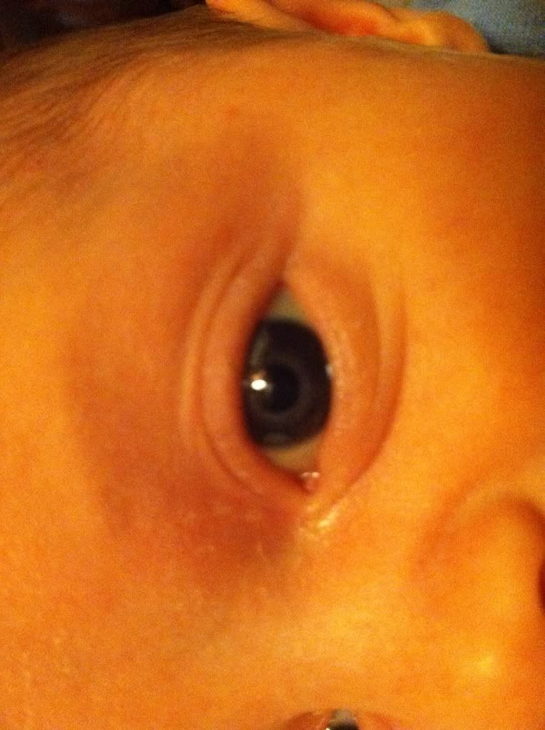 red ring around pupil of eye red ring around pupil of eye